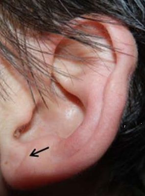 耳朵上有这种褶表示心脏有问题